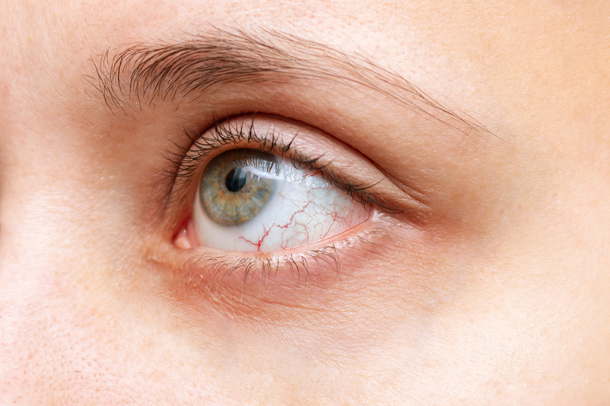 Close-up of woman's eye with red inflamed and dilated capillaries. Dry eye syndrome, trauma, uveitis